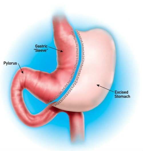 gastric sleeve