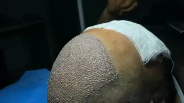 Hair Transplant