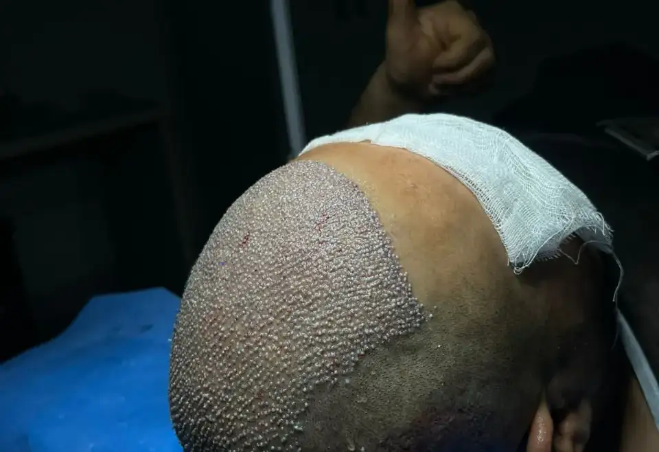 Hair Transplant